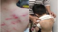 3歲童背現20血痕疑遭虐打幼園:CCTV壞了(圖)