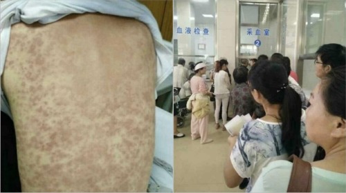 湖南中学爆肺结核疫情，有学生因为药物反应而背部出现红疹。