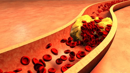 高膽固醇血症可增加心臟病發生的風險。