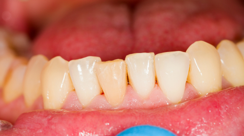 刷牙不当，也会使牙龈萎缩。