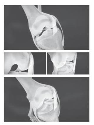 物理性磨损：膝盖弯曲伸直时内侧皱襞与股骨内髁互相摩擦