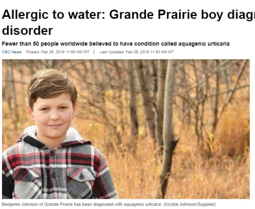 不可思议！加拿大男孩竟对水过敏全球不到50人