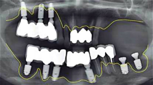 一位患者的口腔X光片，过度耗氧使齿槽骨头流失而变得不堪使用。