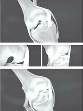 物理性磨损：膝盖弯曲伸直时内侧皱襞与股骨内髁互相摩擦。
