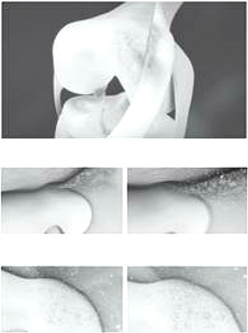 化学性破坏：内侧皱襞发炎会释放出有毒化学物质侵蚀关节软骨。