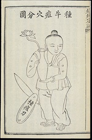 種牛痘穴分圖，取自清朝醫生朱純嘏《痘疹定論》。