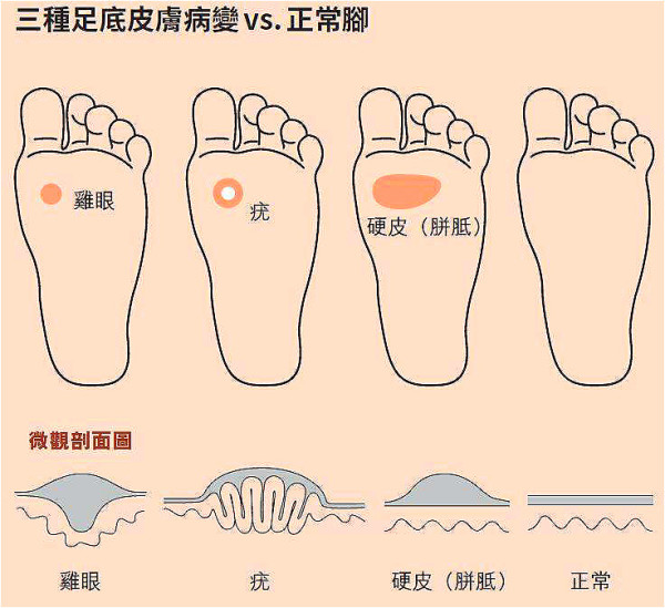 3种脚底皮肤病变图