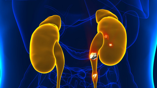 腎結石是腎臟病中最常見的疾病。