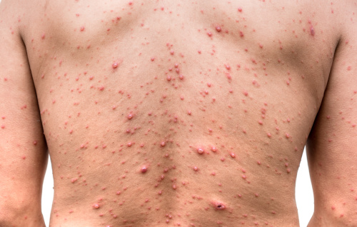 带状泡疹患者会在皮肤上产生一块疼痛的水泡、皮疹。