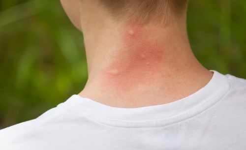 夏天一到蚊蟲多，8種方法來止癢，效果好