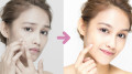 除痣妙招臉變漂亮了(圖)