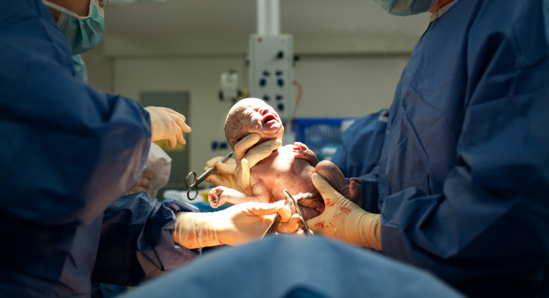 剛出生的寶寶，因為產道擠壓，腦袋會尖尖的，像個錐子。