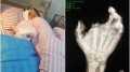 國產手機突爆炸12歲男童食指炸飛眼失明(組圖)