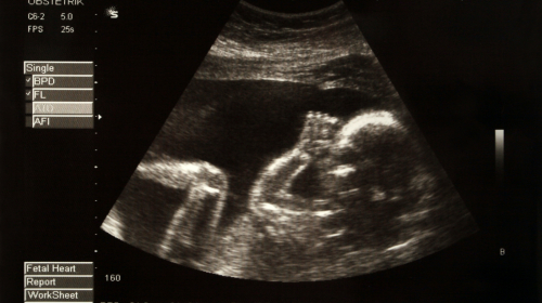超音波产检所拍摄到的宝宝。