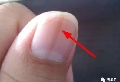 指甲出现黑线是癌症前兆