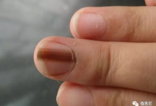 指甲出現黑線是癌症前兆
