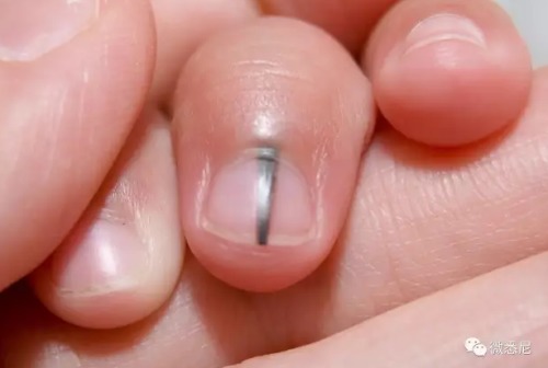 指甲出现黑线是癌症前兆